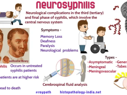 neurosyphilis