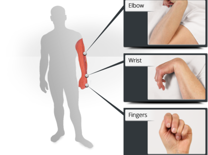 spasticity
