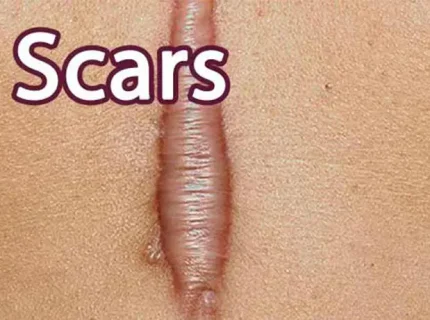 scar