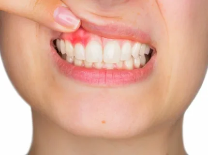 gum