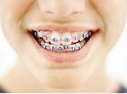 brace